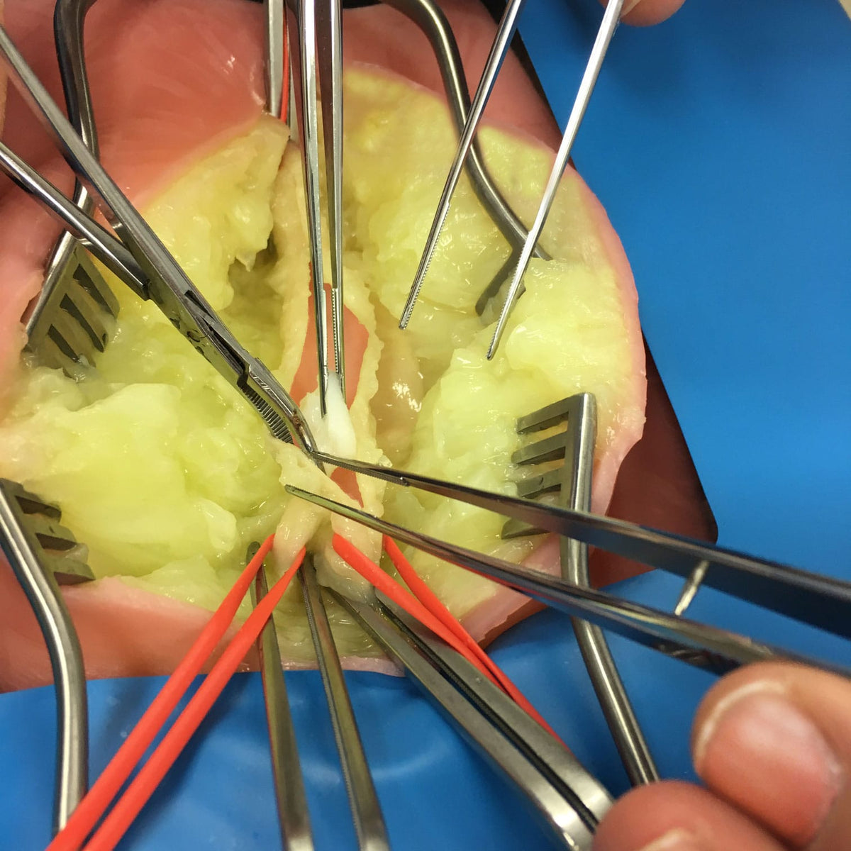 LifeLike Embedded Femoral Groin Model – Endarterectomy Simulator - Vascular Surgery Training