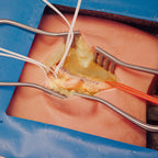 LifeLike Embedded Femoral Groin Model – Endarterectomy Simulator - Vascular Surgery Training
