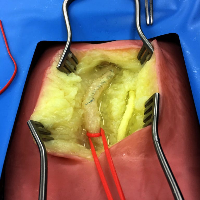 LifeLike Embedded Femoral Groin Model – Endarterectomy Simulator - Vascular Surgery Training